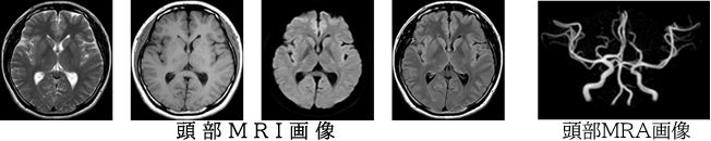 MRI画像